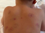 Губернатор Владимиров: малыша в детсаду Минвод могли покусать сверстники
